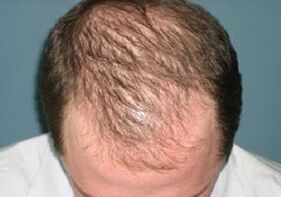 Ursachen für Haarausfall