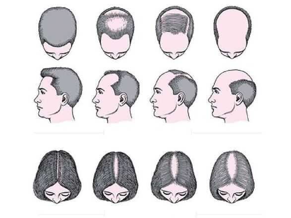 Androgenetische Alopezie bei Männern und Frauen