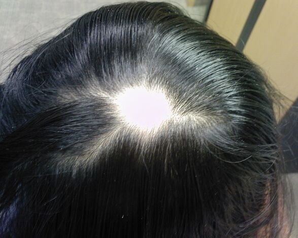 Alopecia areata oder Alopecia areata bei Frauen