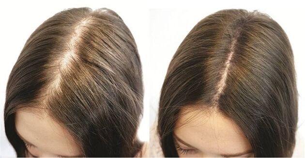 Das Ergebnis einer rechtzeitigen Behandlung von Alopezie bei Frauen