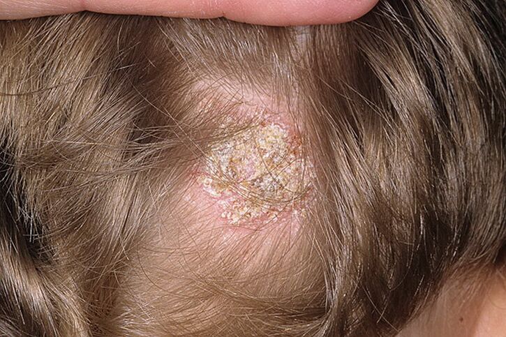Seborrhoische Alopezie bei Frauen