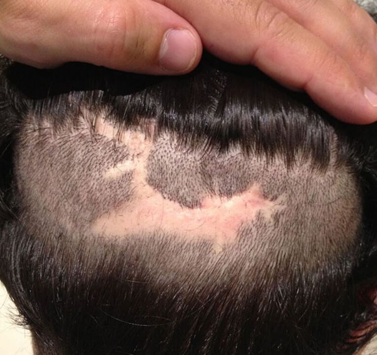 Narbenalopezie der Kopfhaut