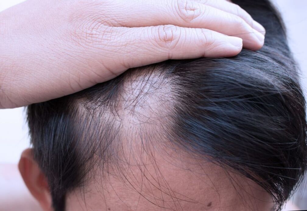 diffuse Alopezie des Kopfes