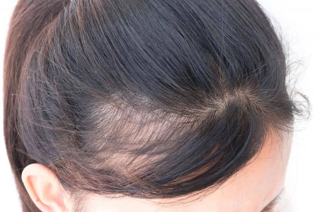 Androgene Alopezie bei Frauen
