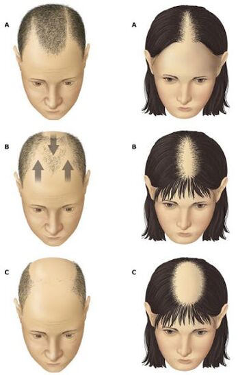 Androgene Alopezie bei Männern und Frauen
