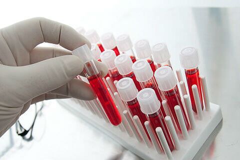 Bluttest zur Verschreibung einer individuellen Behandlung bei Alopezie