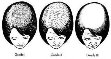 Grad der androgenen Haarausfall bei Frauen