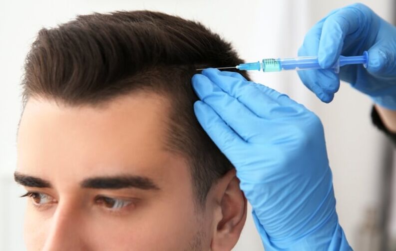 Mesotherapie zur Stimulierung des Haarwachstums bei androgener Alopezie